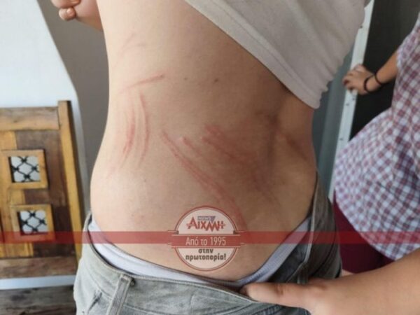 aitoliko epithesi skilou paidi